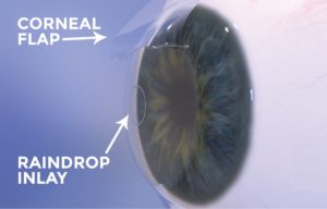 Raindrop eye surgery