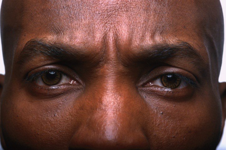 Causes and Remedies for Dry Eyes