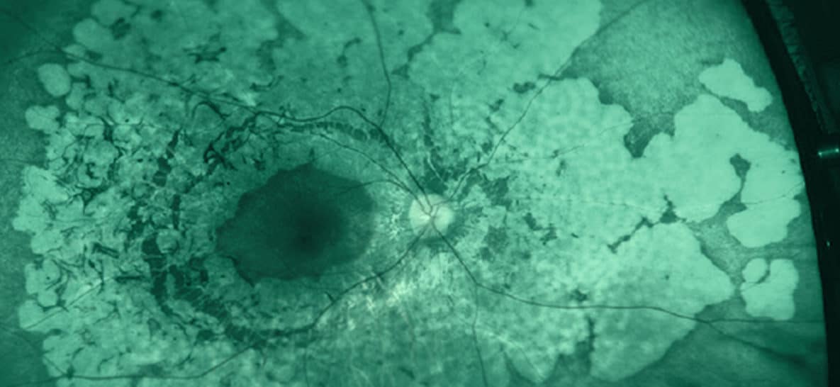 Optomap Imaging: The Optimal Step During an Eye Exam