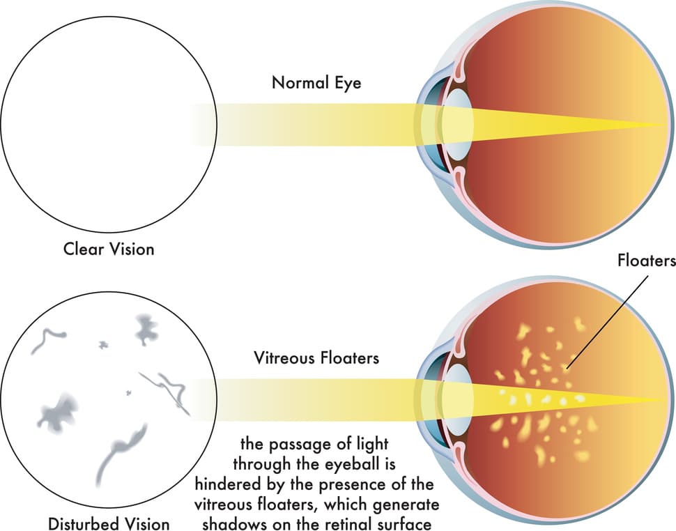 Eye floaters diagram