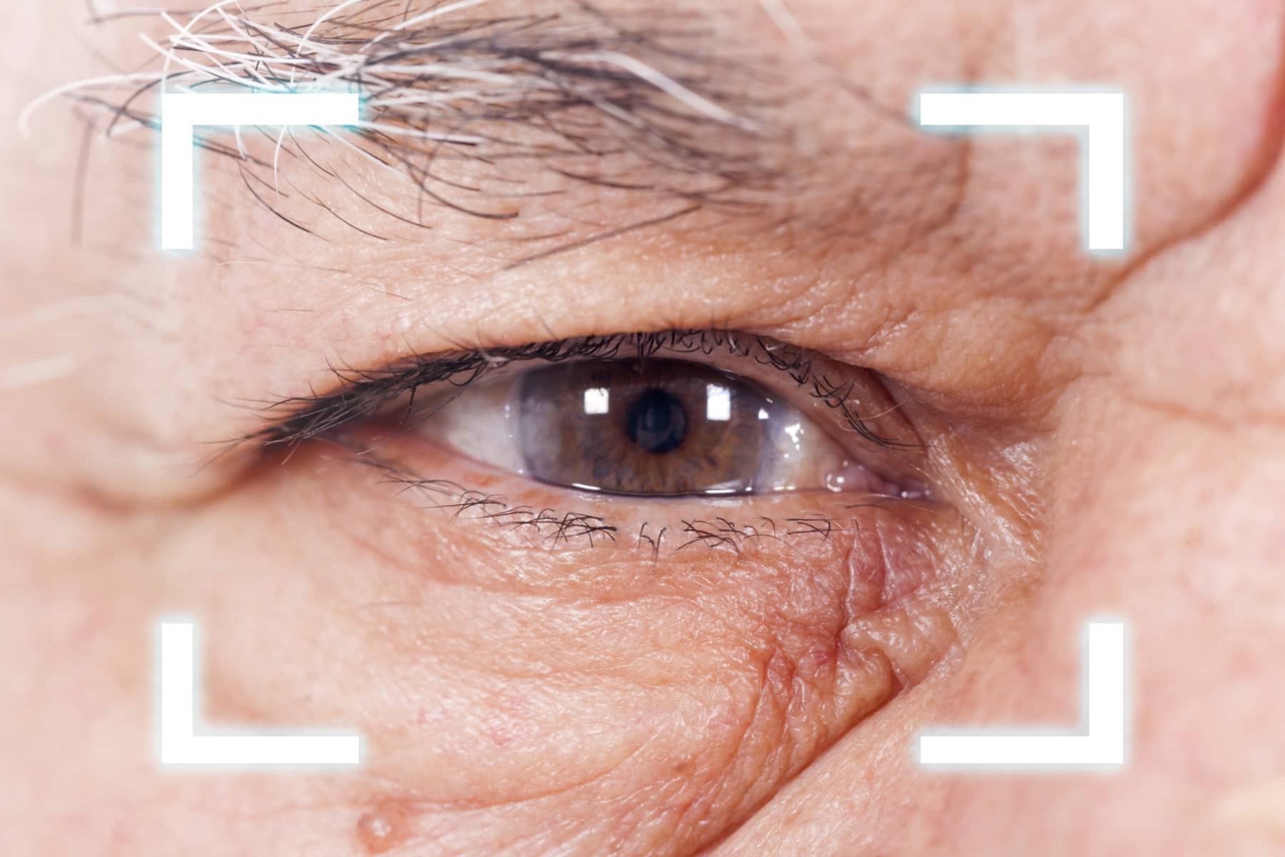 Refractive Cataract Surgery FAQ: The natural lens is replaced with an advanced multifocal lens rather than a standard synthetic lens in order to correct your vision. Refractive cataract surgery can correct shortsightedness, farsightedness, and astigmatism.