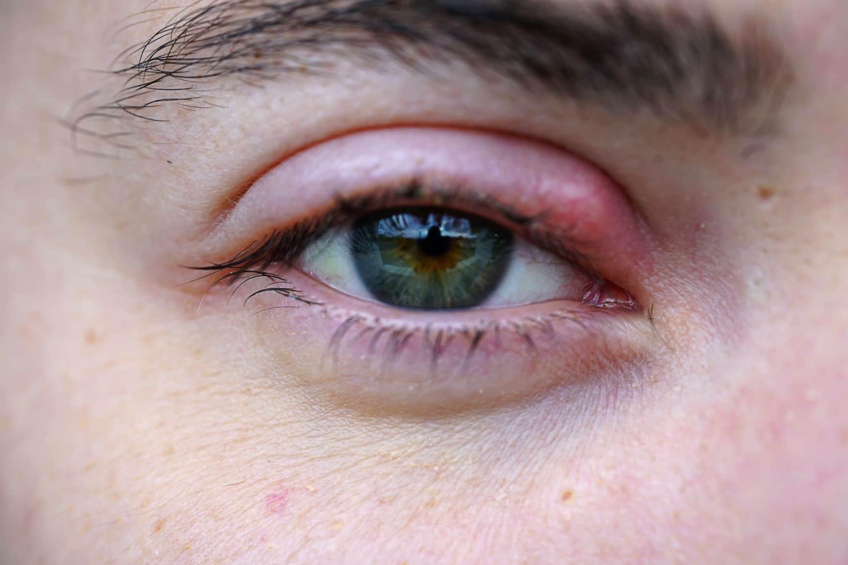 An eye stye, as shown here, usually goes away on its own. If it does not or gets worse, make an appointment to see one of our eye doctors.