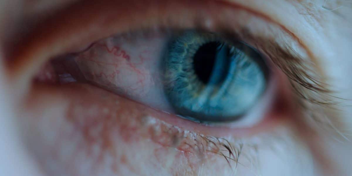 Ocular rosacea symptoms eye redness