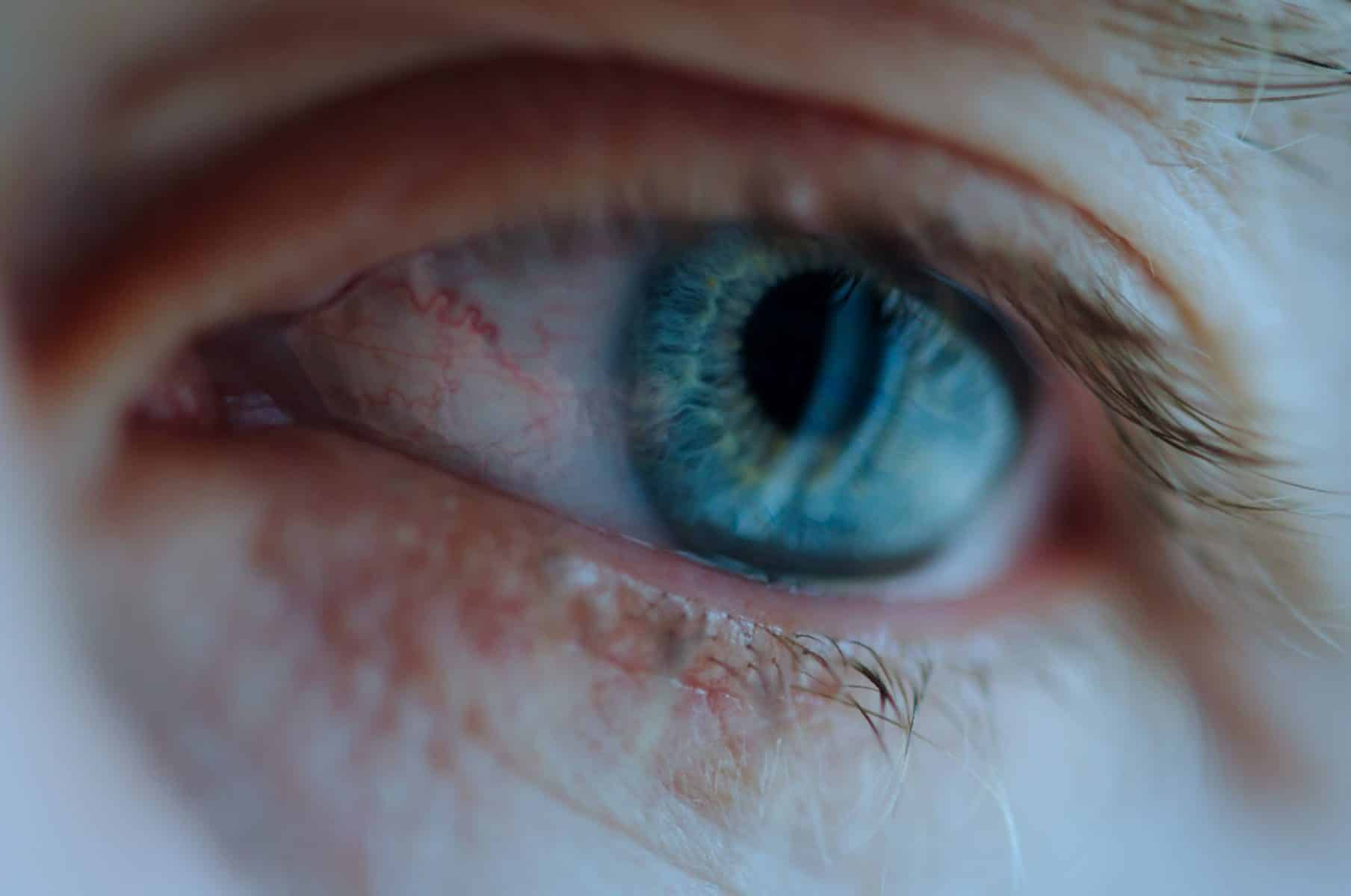 Basic Facts About Ocular Rosacea Causes Symptoms And Treatment 