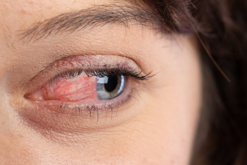 Ocular Rosacea Treatment Symptoms And Causes Michigan Eye Institute 