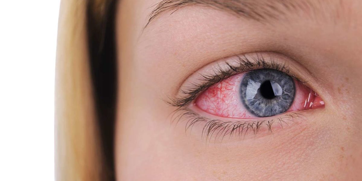 Red eye can be caused by many factors, including seasonal allergies, corneal abrasions, alcohol or drug use, infection, and trapped particles.
