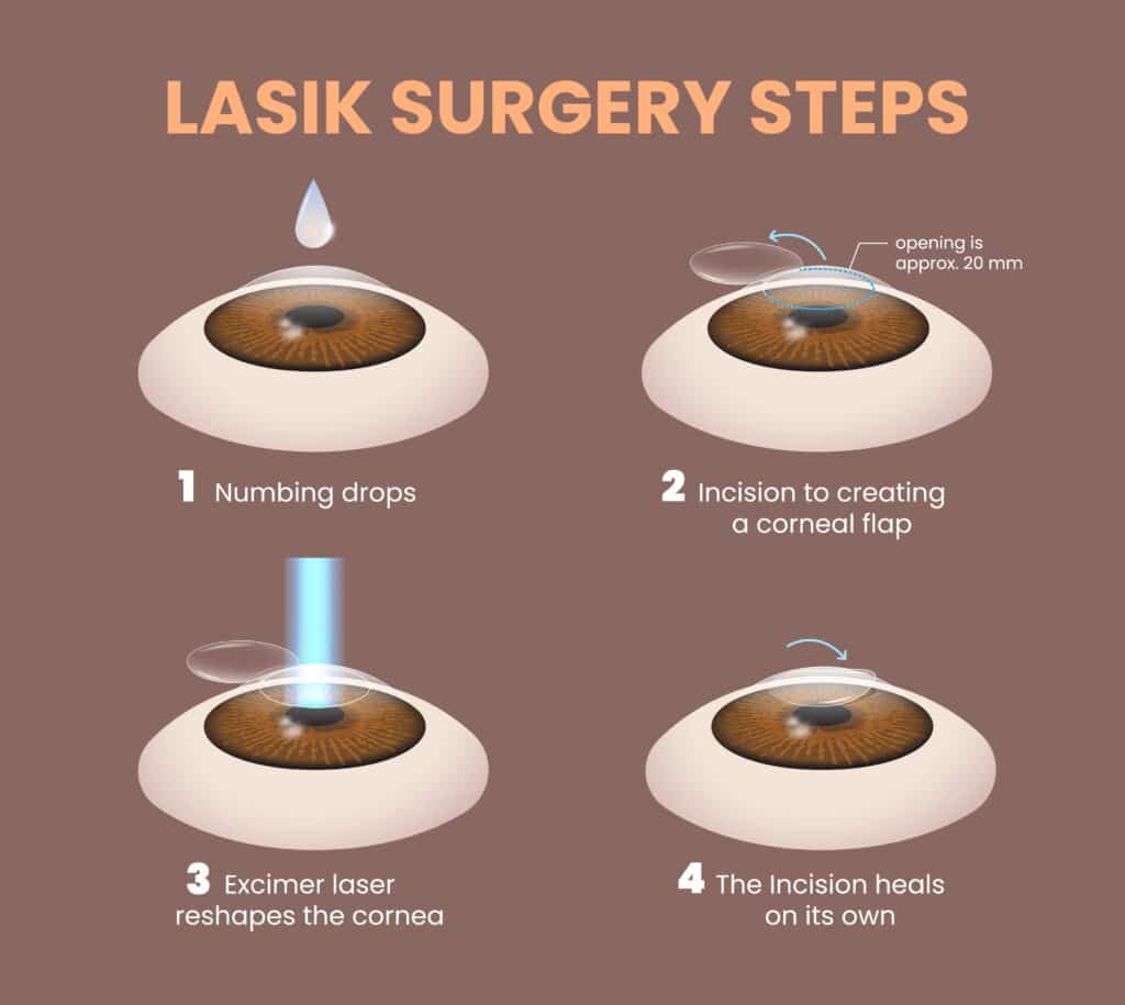 lasik procedure