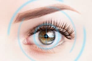 LASIK for nearsightedness